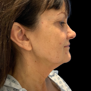 before-deep-plane-facelift-necklift-blepharoplasty